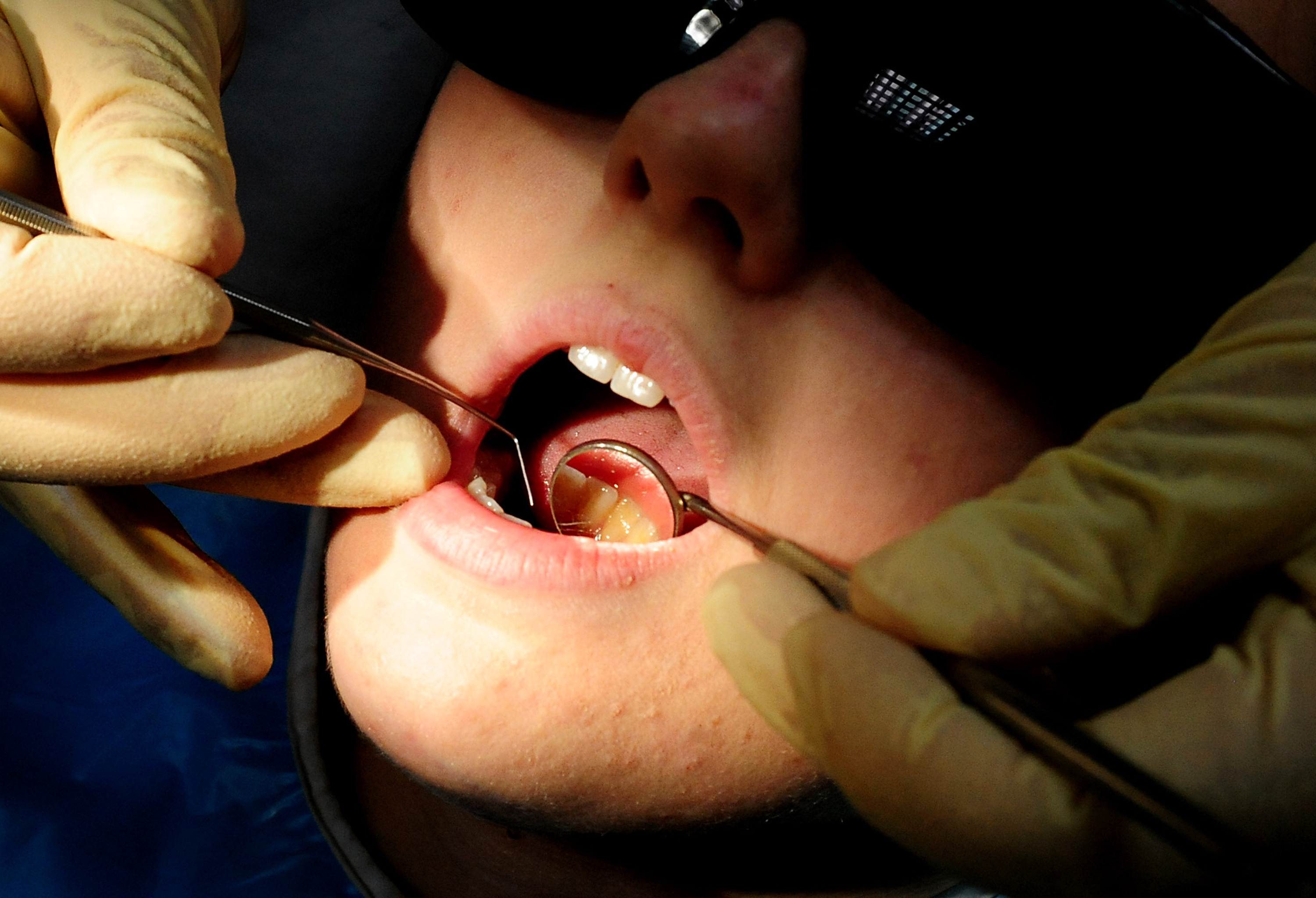 More than a dozen hospital admissions in West Devon to remove children's rotten teeth