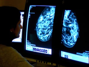 More women in Devon undergo breast cancer screening – as NHS England target met for first in five years