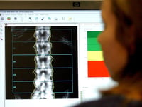 A fifth of people in Devon suffer joint, bone and muscle conditions
